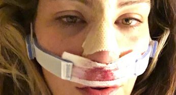 Aposentada, Miesha Tate posta foto de cirurgia no nariz