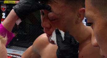 Chinês sofre fraturas múltiplas no rosto e lesão ocular após ‘bola de tênis’ em derrota brutal no UFC